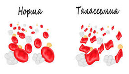 Талассемия