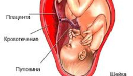 Преждевременная отслойка плаценты
